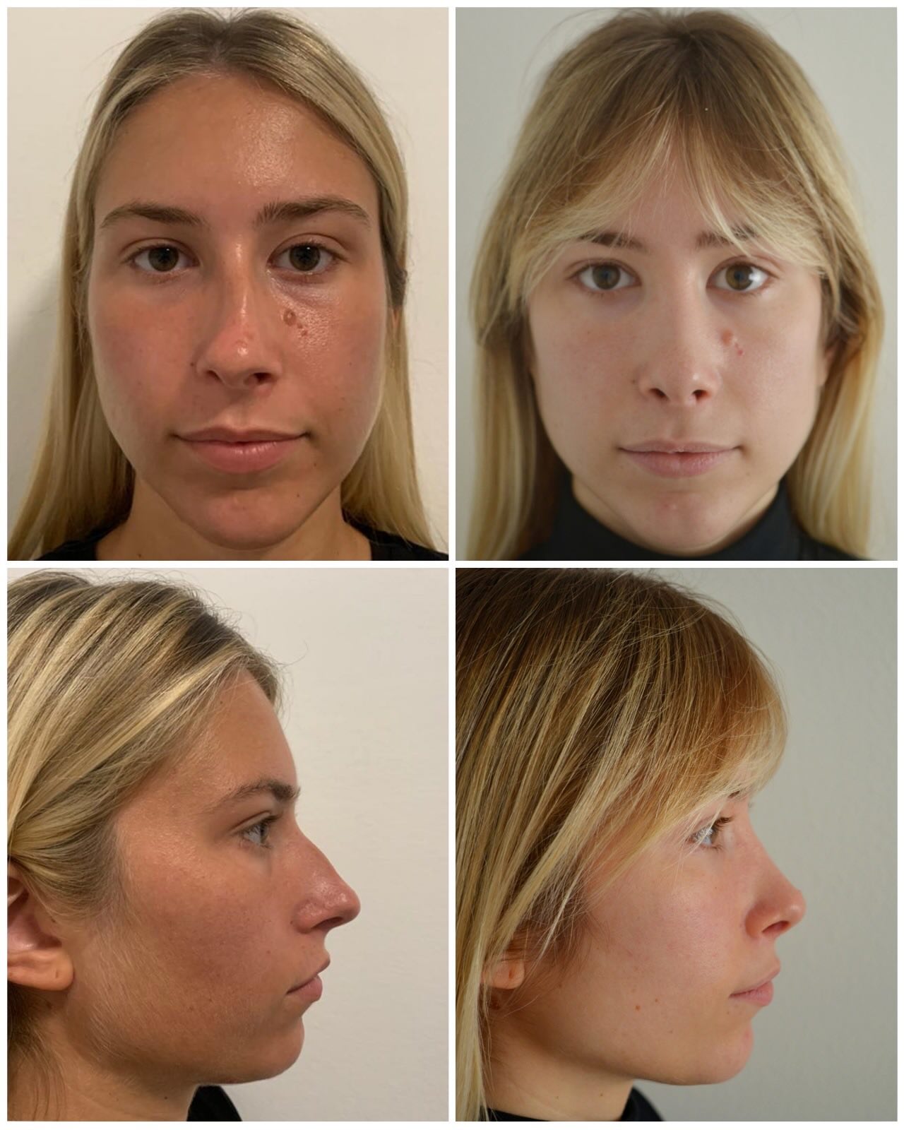 Before and after images of a female patient who underwent rhinoplasty. The images show the face from the front and in profile before the procedure (left) and after the procedure (right), with visible improvement in the shape and profile of the nose.