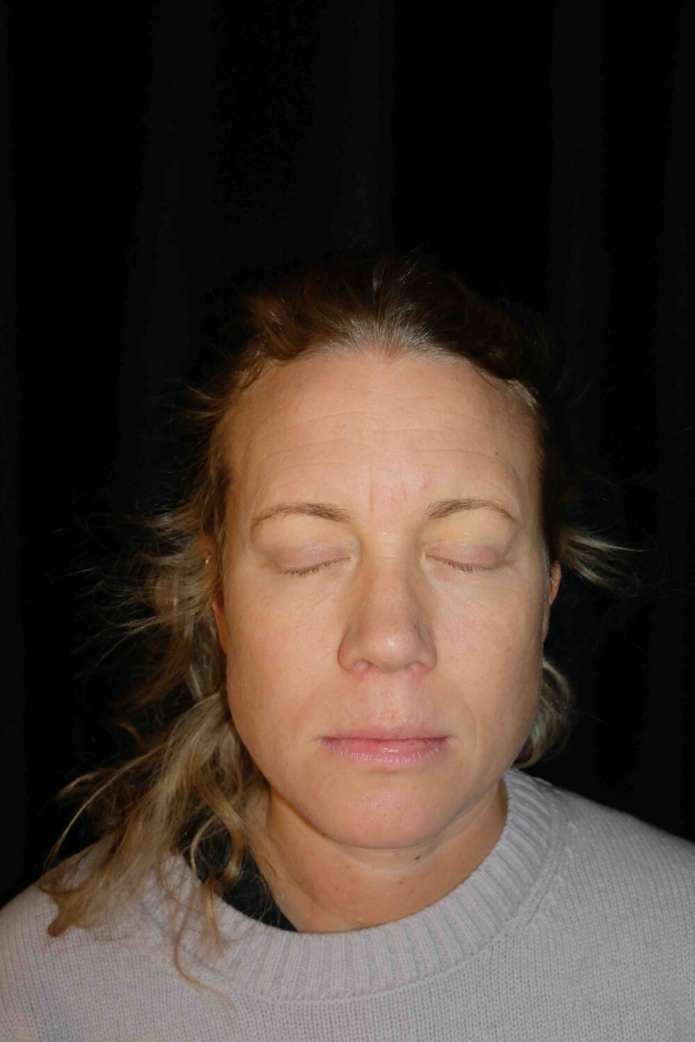 blepharoplasty