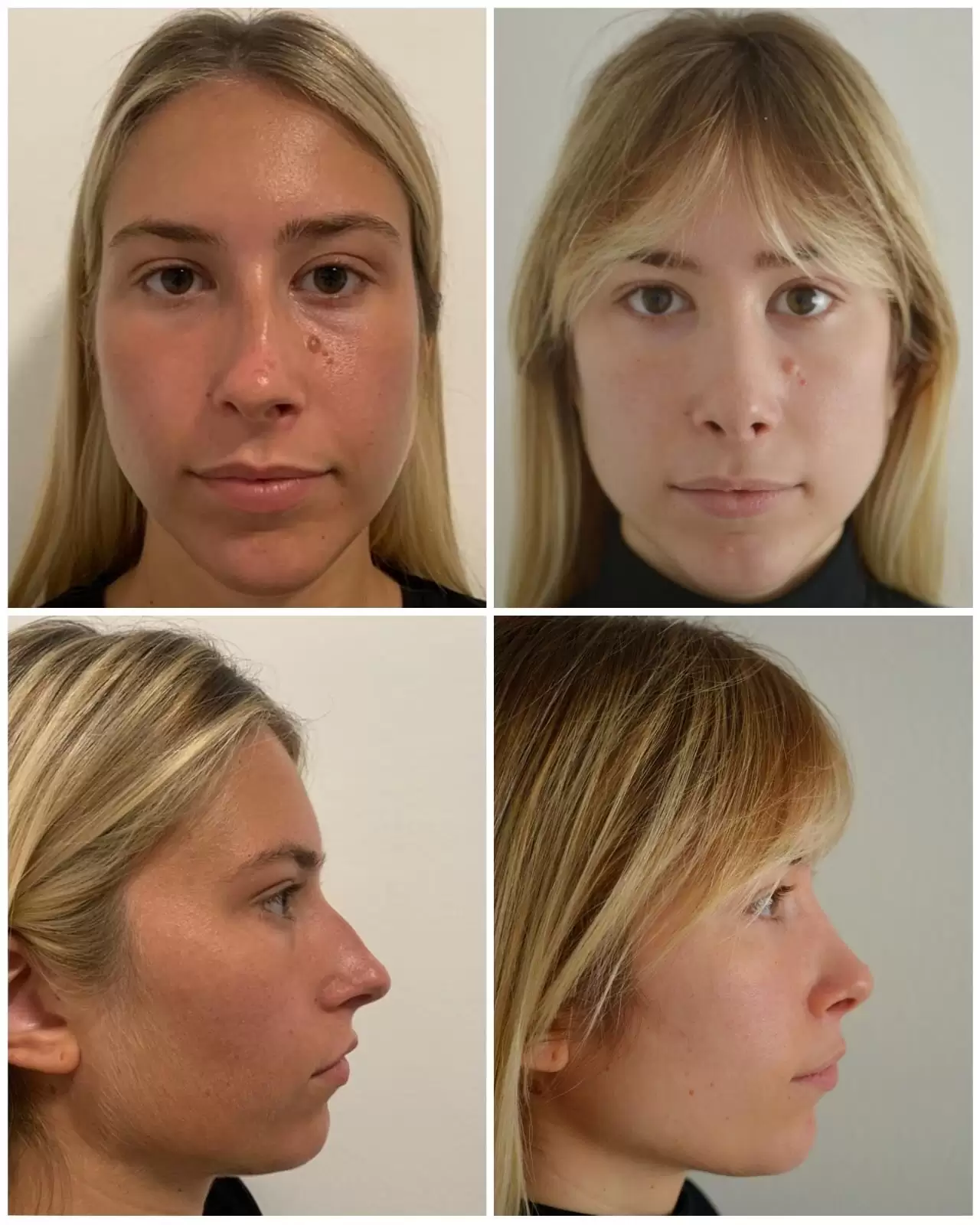 Before and after rhinoplasty