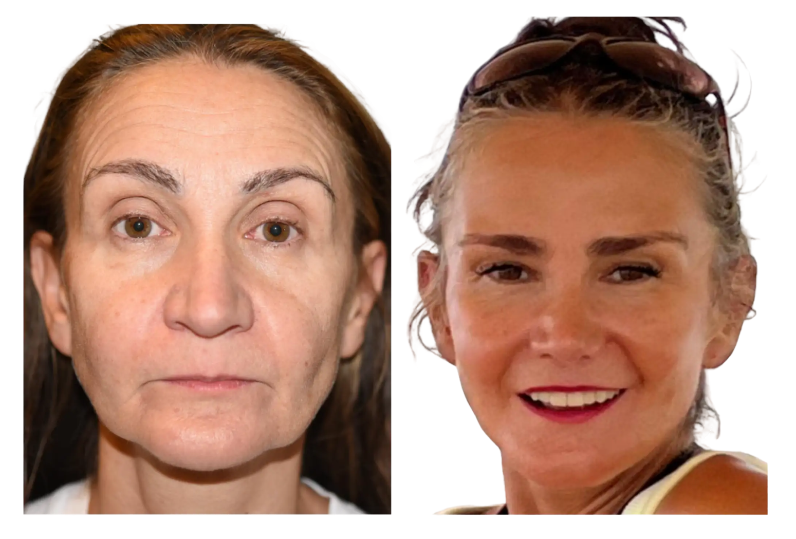 deep plane facelift