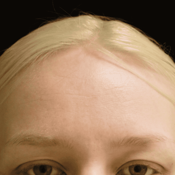 Endoskopiskt pannlyft – Kvinna – före (Framifrån)