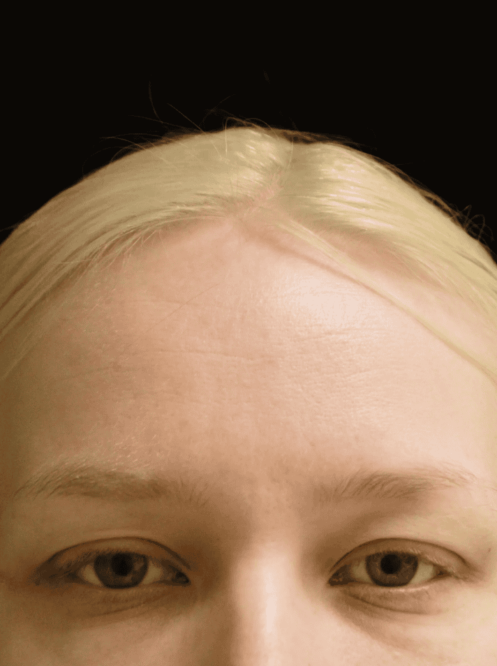 Endoskopiskt pannlyft – Kvinna – före (Framifrån)