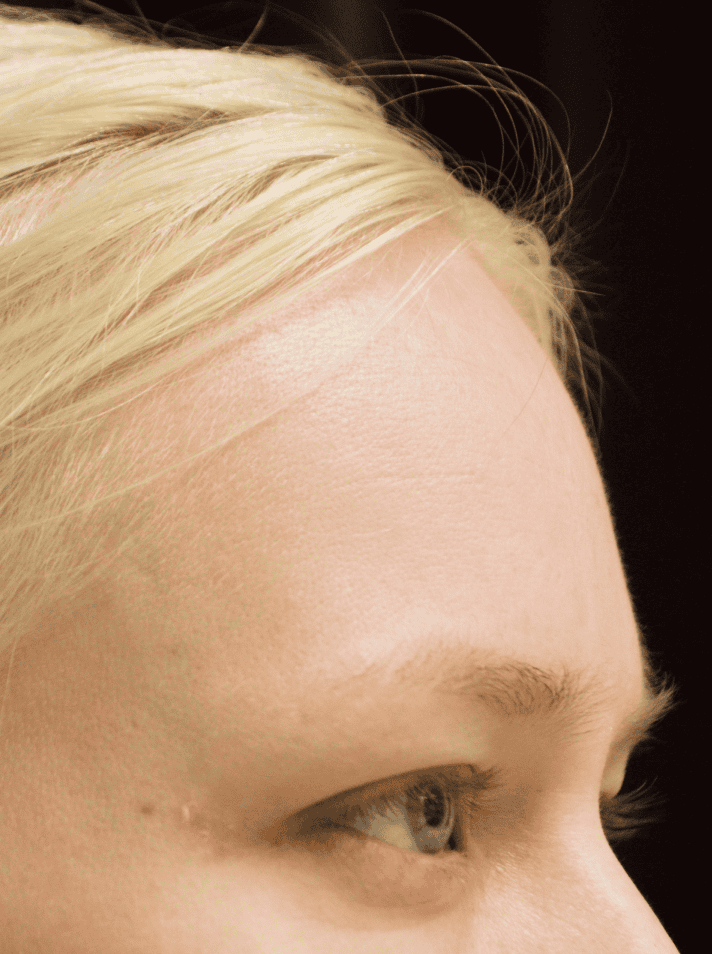 Endoskopiskt pannlyft – Kvinna – före (Profil)