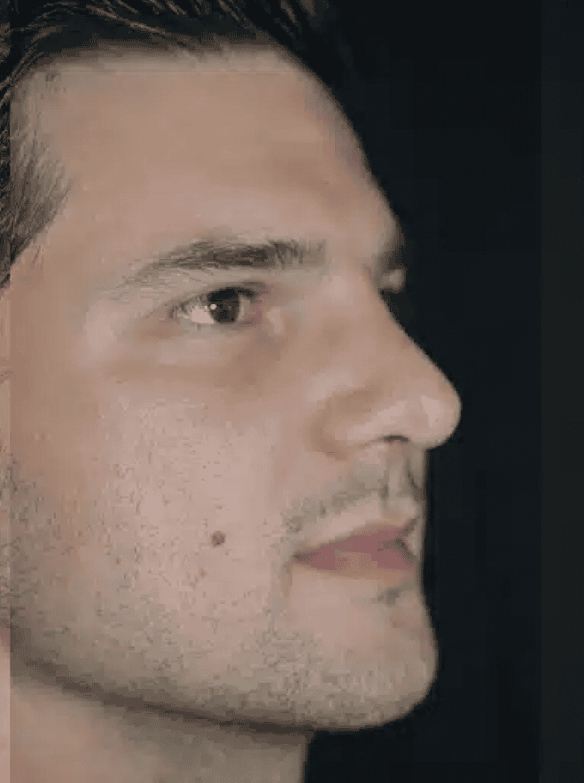 Man efter näsplastik, ansikte i profil.